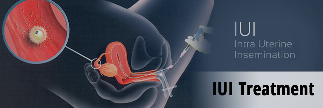 IUI Treatment Delhi how much does cost of intrauterine insemination